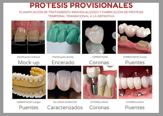Laboratorio Dental Miguel Eizaguirre prótesis provisional 2