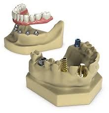 Laboratorio Dental Miguel Eizaguirre proceso de implante dental